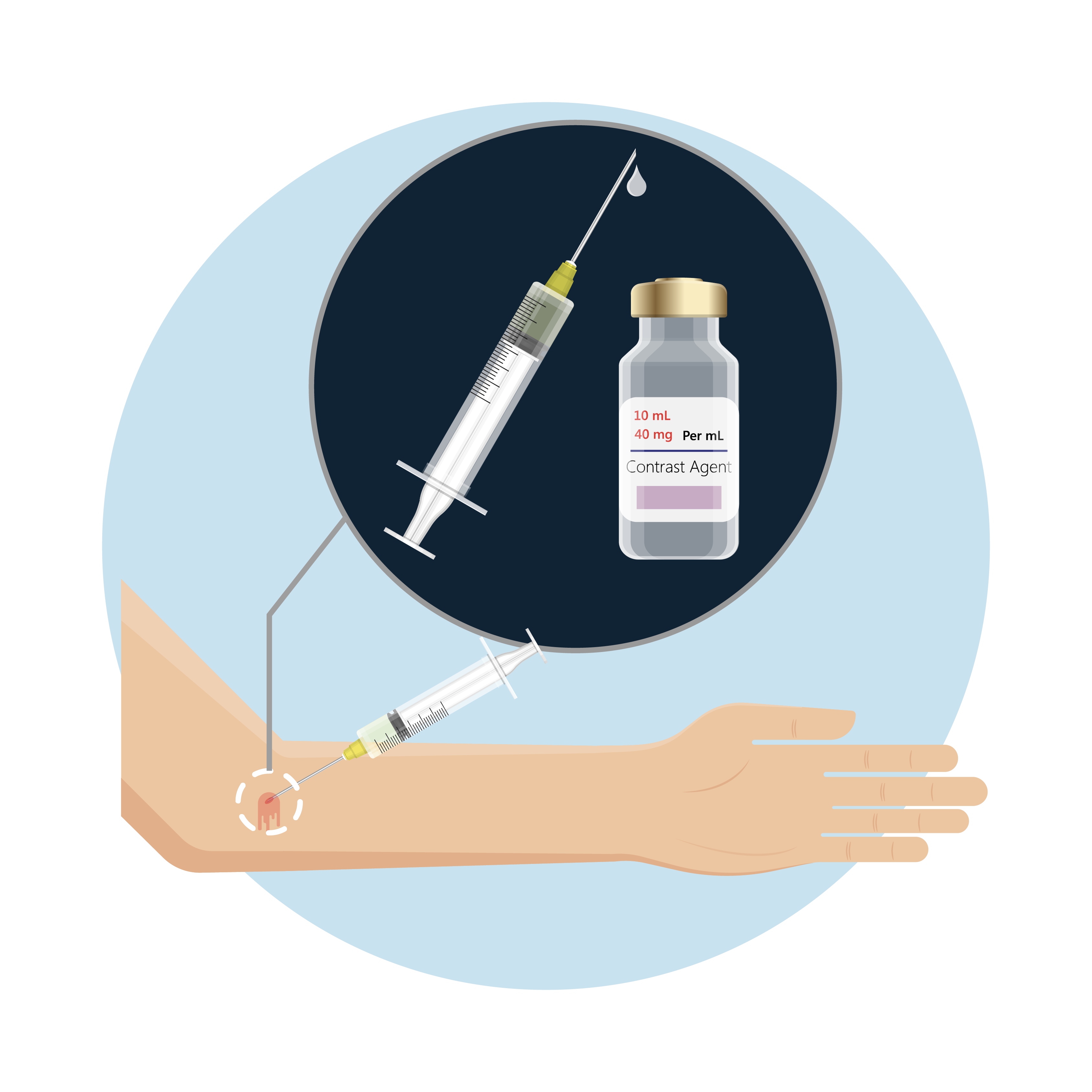 El tinte de contraste se inyecta a través de la vía i.v.