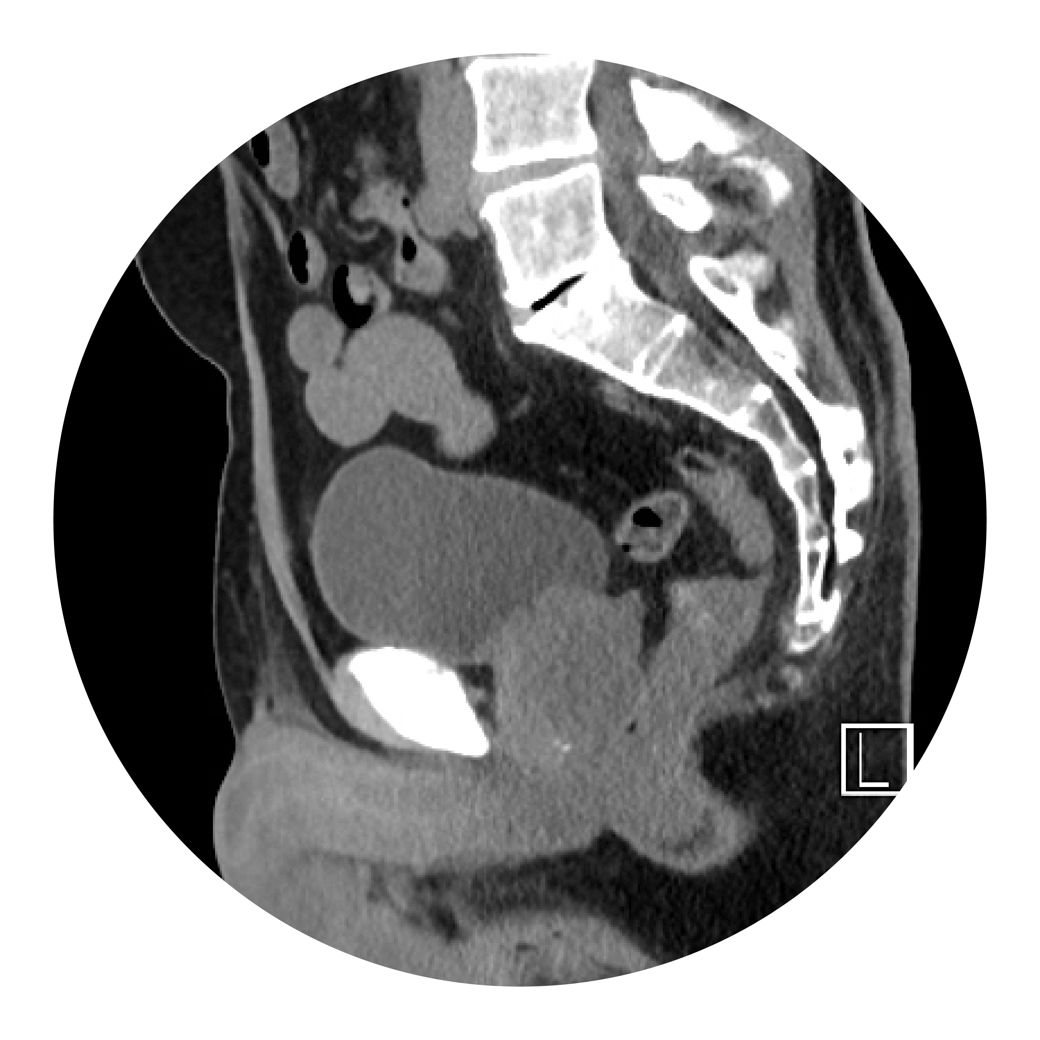 Por último, se realiza una última exploración a medida que el tinte drena hacia la vejiga.