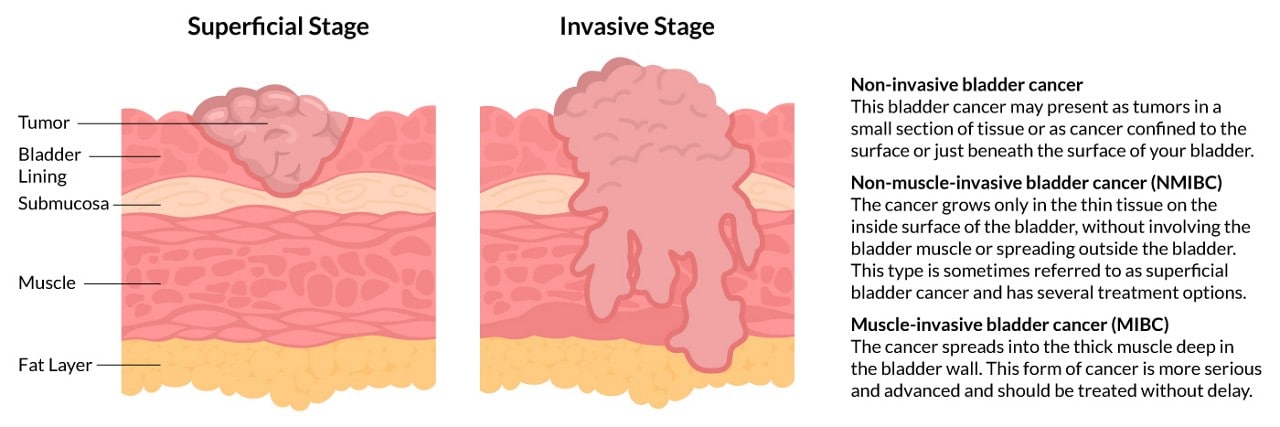 muscle invasive bladder cancer