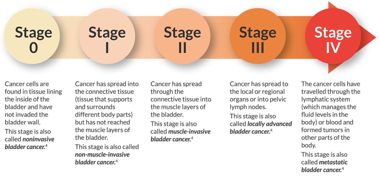 stages of bladder cancer