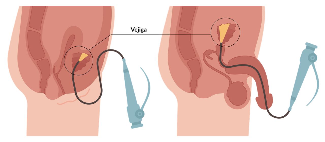 cytoscopy