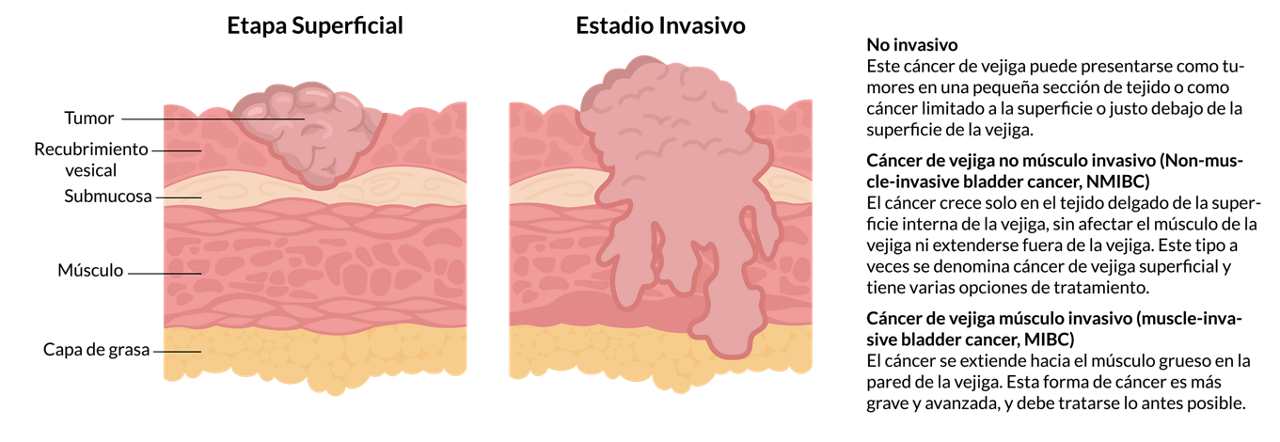 muscle invasive bladder cancer